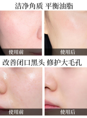 果酸焕肤黑头刷酸去痘痘痘印鸡皮肤薇诺娜20%35%50%70%带防伪码