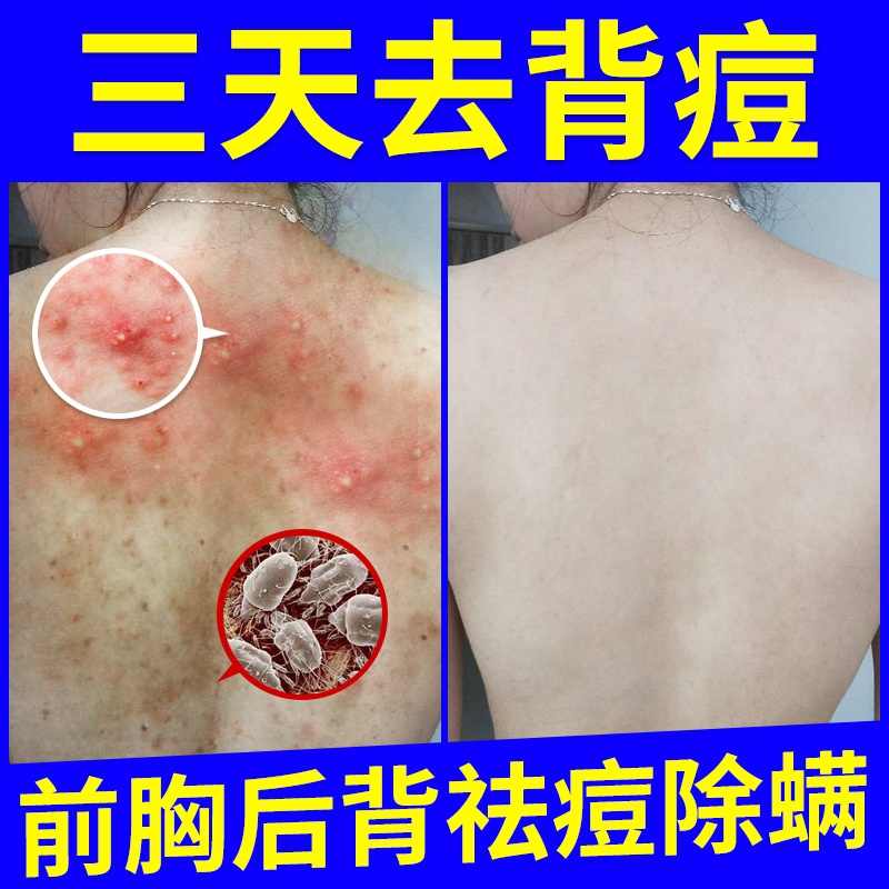 除痘痘神器 新人首单立减十元 21年9月 淘宝海外 除痘痘神器 新人首单立减十元 21年9月 淘宝海外