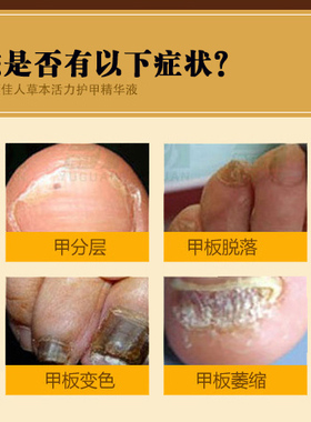 指甲增长液生长生甲液长甲精油快速手指甲脚趾甲受损修复矫正再生