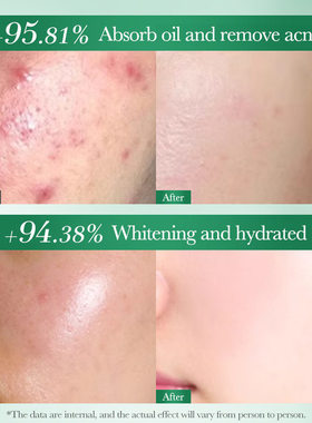 茶树水杨酸洗面奶Tea Tree Anti-Acne Whitening Facial Cleanser