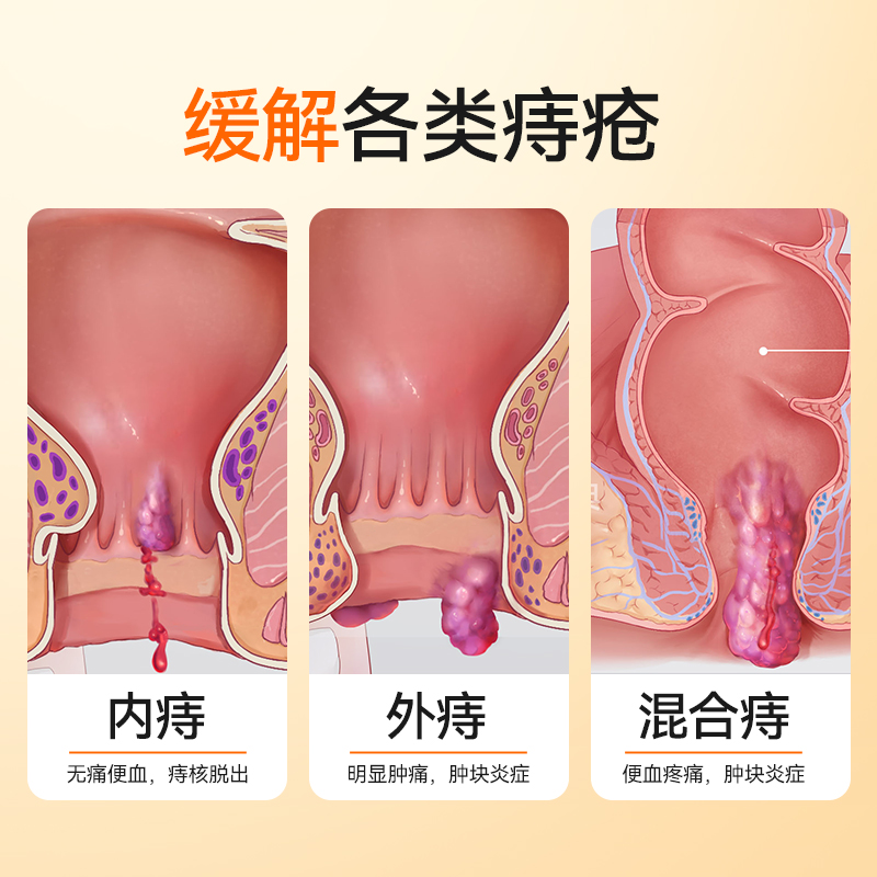 医用敷料痔疮凝胶痔疮膏卡波姆肛门坠胀疼痛便血内外混合痔消肉球