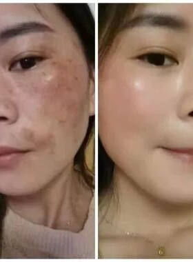 章fei线下美院直发强效特效型祛斑液顽固色斑去雀斑黄褐斑黑色素