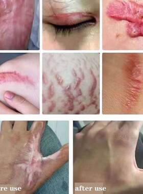 Acne Scar Removal Cream Repair Maternity Stretch Marks Gel R