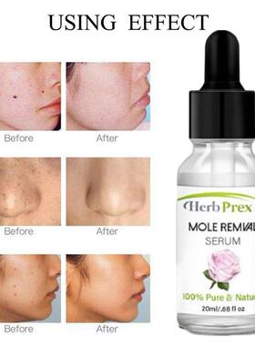 Skin Tag Removal Solution Painless Mole Skin Dark Spot Remov