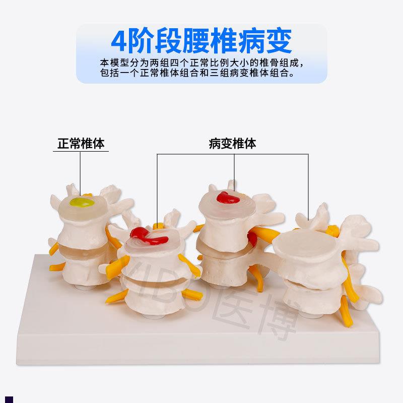 医博BIX-A3561人体腰椎间盘突出病变演示模型人体脊柱腰椎模型人O - 图0