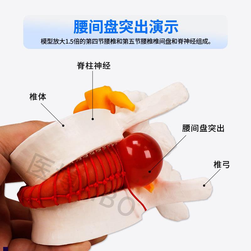 医博BIX-A3561人体腰椎间盘突出病变演示模型人体脊柱腰椎模型人O - 图1