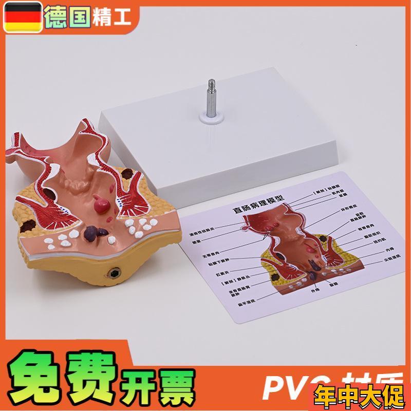 德国】新款大促爆款人体模型肠A直肠解剖病理模型病态疾病教具模 - 图2