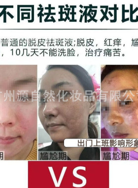 祛真皮斑祛斑液去斑液敏感提取液老年斑祛斑液分解黑色素不挂网