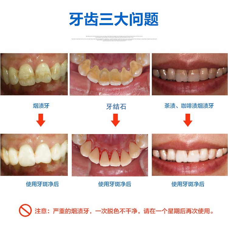 洗牙粉去黄洗白去牙垢美白速效黄牙洗牙齿污垢除牙石烟渍清洁神器