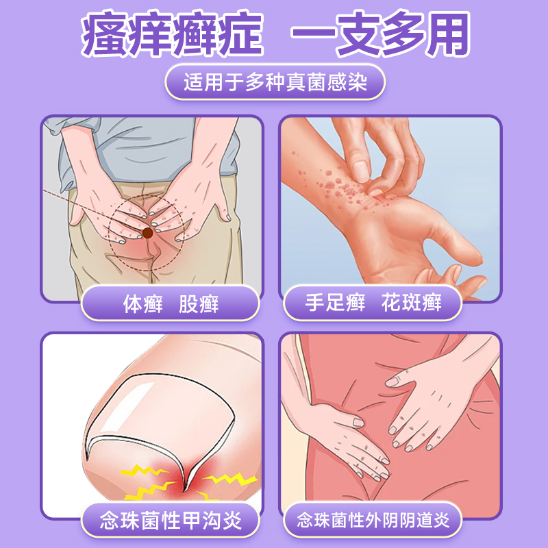 妇炎洁克霉唑乳膏股癣手足癣花斑癣甲沟炎阴道炎外阴瘙痒止痒软膏