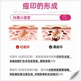 Крем ретиноевой кислоты для медицинского крема из изотретиновой кислоты Официальный флагманский магазин ретиноевой кислоты крем для латекса против крема ретиноевой кислоты