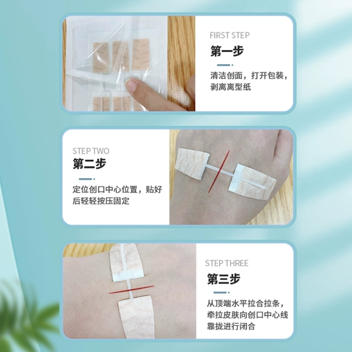 Медицинское тензором Цезарная кожа кожа кожа кожа Тисан Ранки Рань Раны Детские послеоперационные смахивание шьвы заживление Хонгшенг