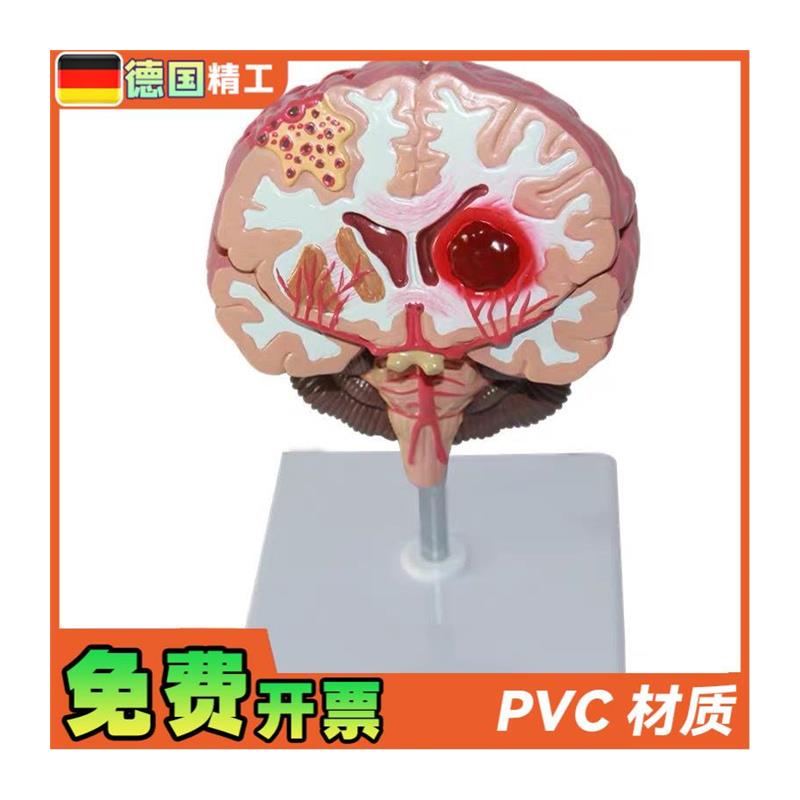 德国】人脑病理解剖模型脑geng大脑疾病血管堵塞标本 教学脑科神 - 图3