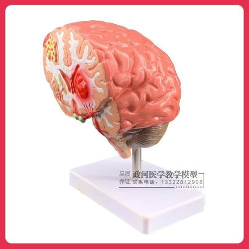 仿真人体脑部疾病模型大脑解剖神经内外科脑病理大Z脑病变模型 - 图2