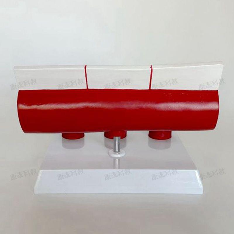 动脉血管模型不同年龄段血u管内膜变化粥样硬化栓子血管狭窄斑块 - 图0