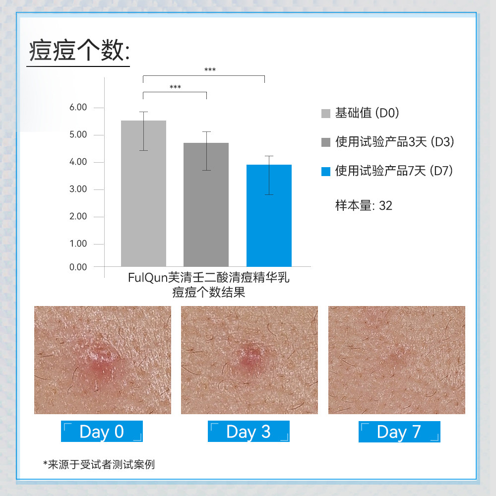 芙清20%壬二酸祛痘精华乳非水杨酸控油淡化祛痘印痘痘闭口粉刺