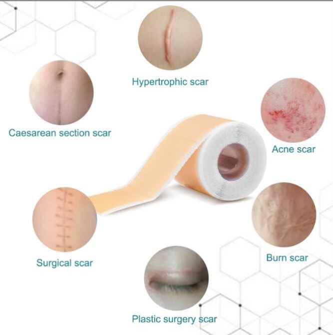ELAIMEI修复贴大尺寸疤痕贴疤痕卷1.5米长隐形修护增生妊娠纹烫伤 - 图2