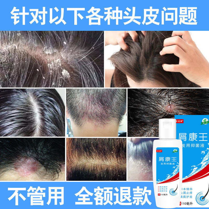 头皮头部正品去屑康王毛囊炎洗发水 雅寿堂保健用品皮肤消毒护理（消）