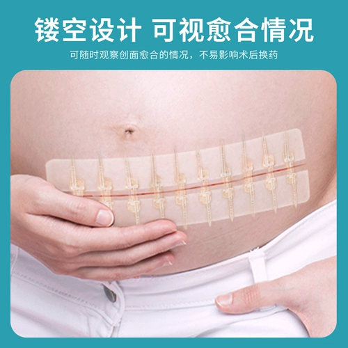 Уменьшите публикацию для медицинских кожных ран для кесарева сечения, уменьшение напряжения типа молнии для кесарева сечения