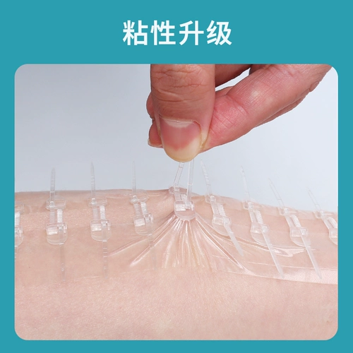 Уменьшите публикацию для медицинских кожных ран для кесарева сечения, уменьшение напряжения типа молнии для кесарева сечения