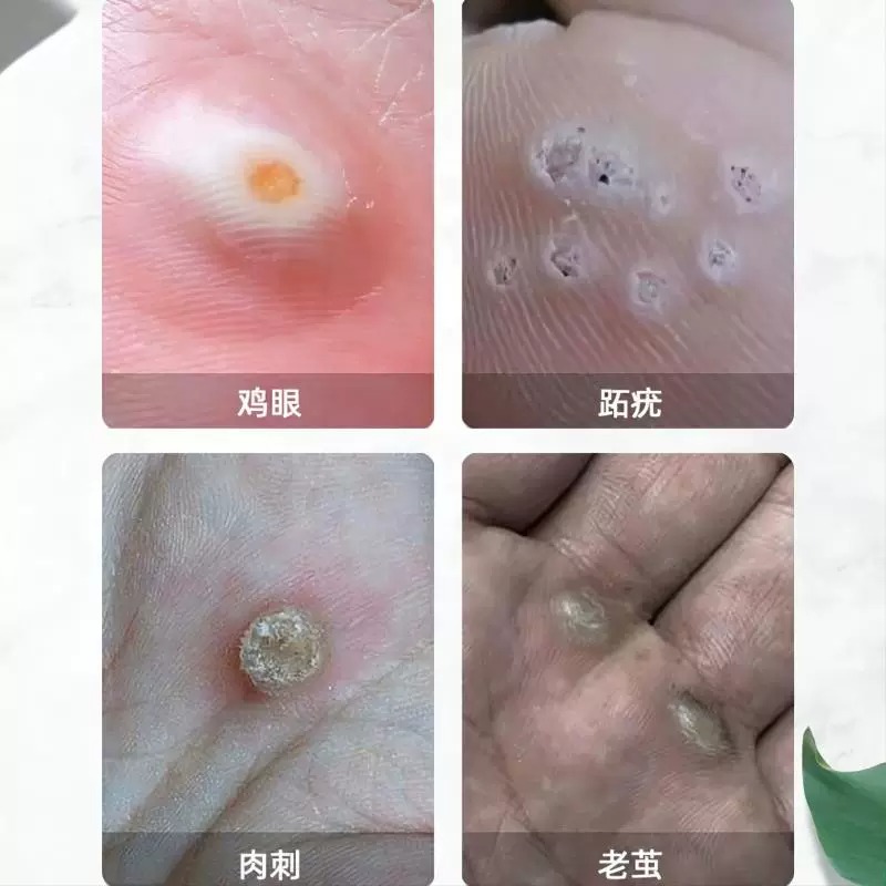 鸡眼膏贴扁平疣丝状寻常跖疣膏瘊子净肉粒去除一抹乳膏无忧鸡眼药 - 图0