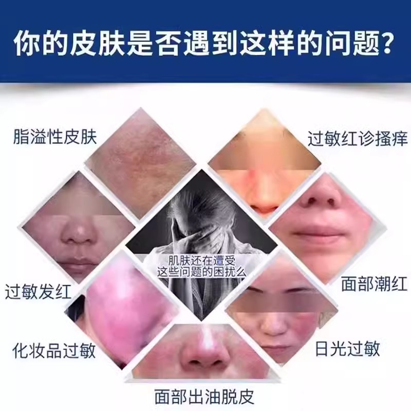 面部脂溢性皮炎鼻子鼻翼修复喷雾面膜面霜剂脸上脸部溢脂性皮炎DS - 图0
