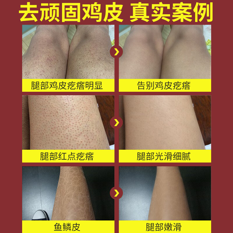 尿素霜百分之十五高浓度正品软膏 哆啦小屋护手霜