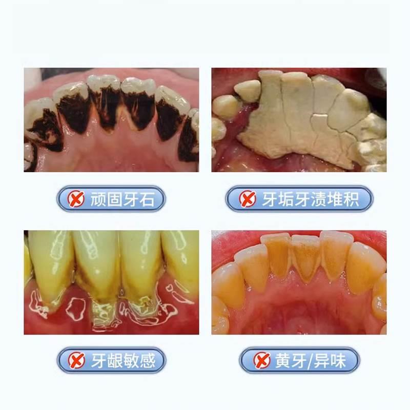 口臭结石型同普堂口咽冲洗器气牙结石旗舰店官方2AK-图0