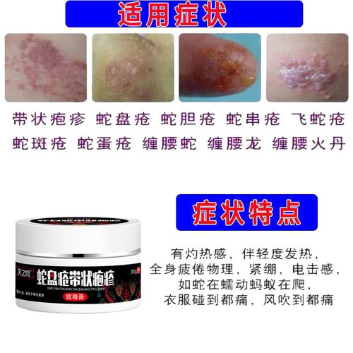 带状疱疹后遗症神经痛神器外用蛇缠腰蛇胆疮病毒膏蛇盘疮止痛克星 - 图1