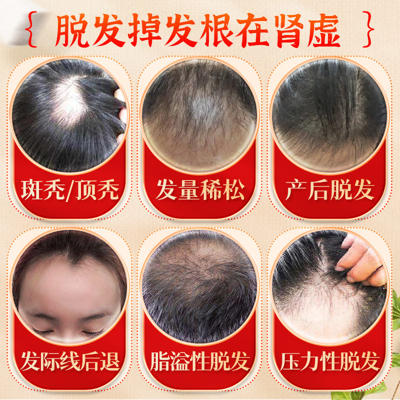 百会生发片90防脱发养血男女士中药 百会白发脱发