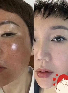 美容院擦斑液雀斑提取液点班点志