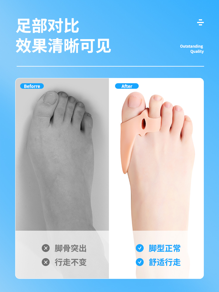 日本硅胶大拇指外翻矫正器大脚骨大脚趾重叠分趾器成人男女可穿鞋 - 图3