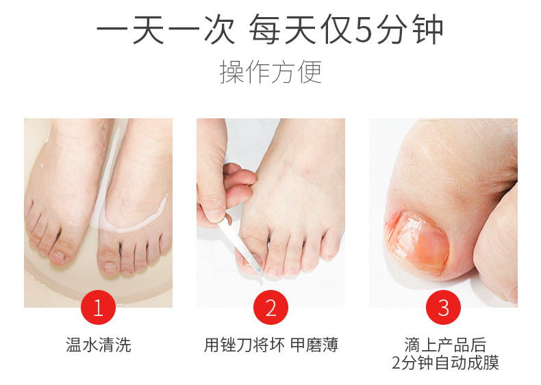 灰指甲正品非治疗药专用液脱甲膏 本义医疗器械保健理疗