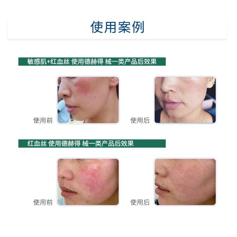 德赫得+液体凝胶套装皮炎湿疹喷剂 德赫得伤口敷料