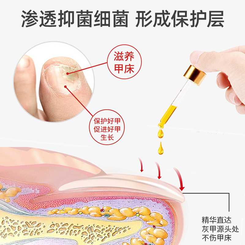 灰指甲专用抑菌液灰甲净冰醋酸软甲脱甲膏修甲修脚刀旗舰店正品 - 图0