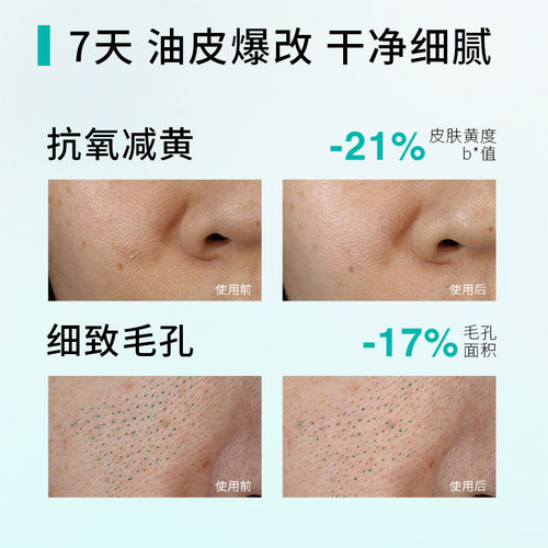 【侯明昊同款】珀芙研油痘调理平衡乳 控油祛痘去闭口油皮水乳液 - 图1