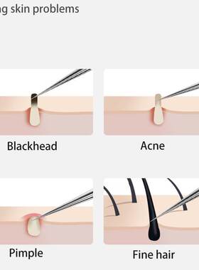 BlackheadRemoverTsPi