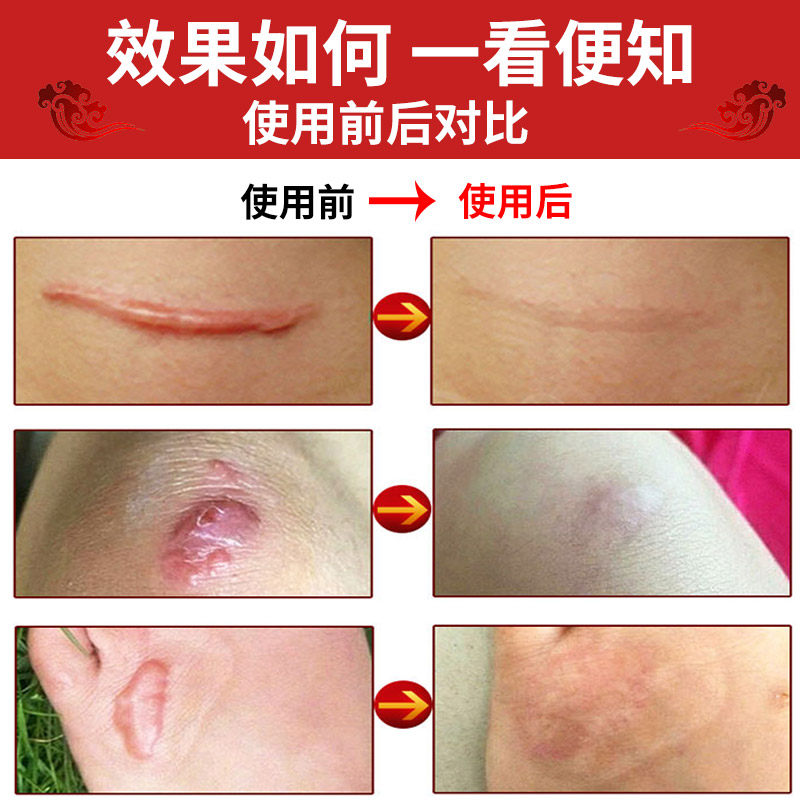 妙丹堂疤痕灵脸部痘印修复手术凝胶 健蓓莱医疗器械祛疤产品
