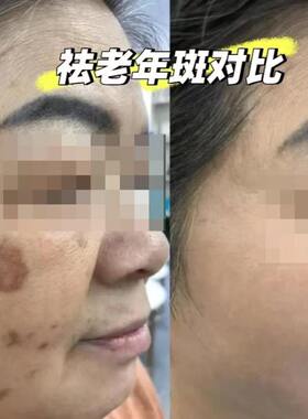 美容院点斑霜无痛提取雀斑点点霜老年斑提取黑点驱斑霜点斑笔