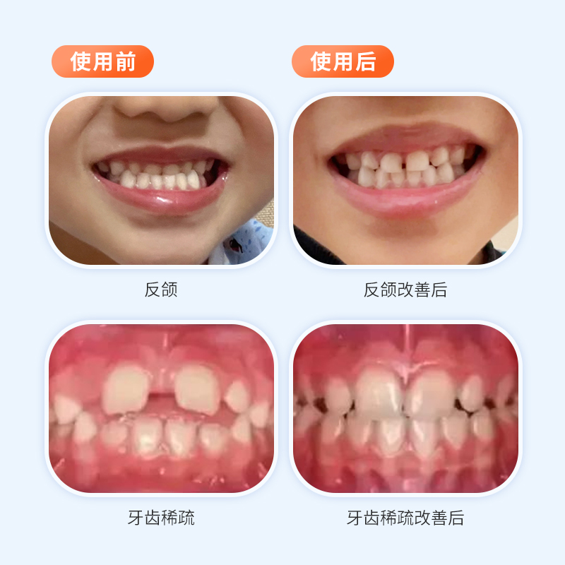 曙美定制式儿童早期干预矫治器嘴凸地包天牙齿矫正器硅胶牙套 - 图3