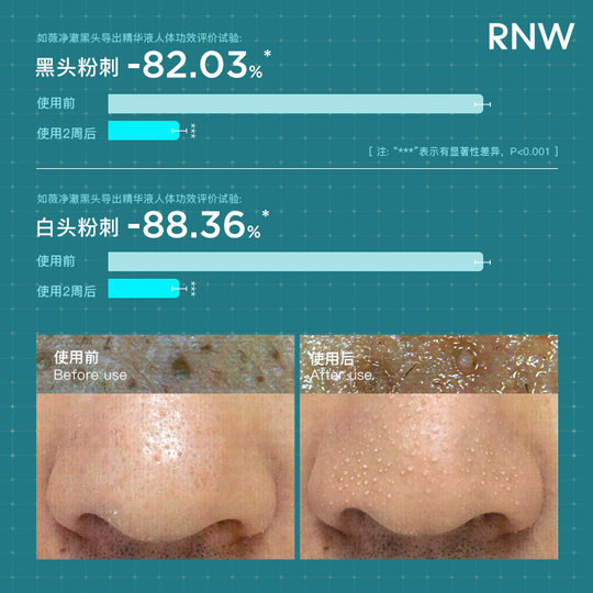 Rnw blackhead export liquid 50ml agua para puntos negros elimina puntos negros, acné, control de aceite, eliminación de acné, limpieza suave de poros y calmante