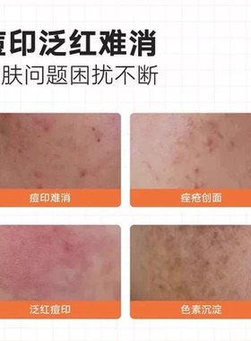 dudp素秀臣氏大橙管护理膜透明质酸钠修护凝胶淡化痘印bzan橙膏