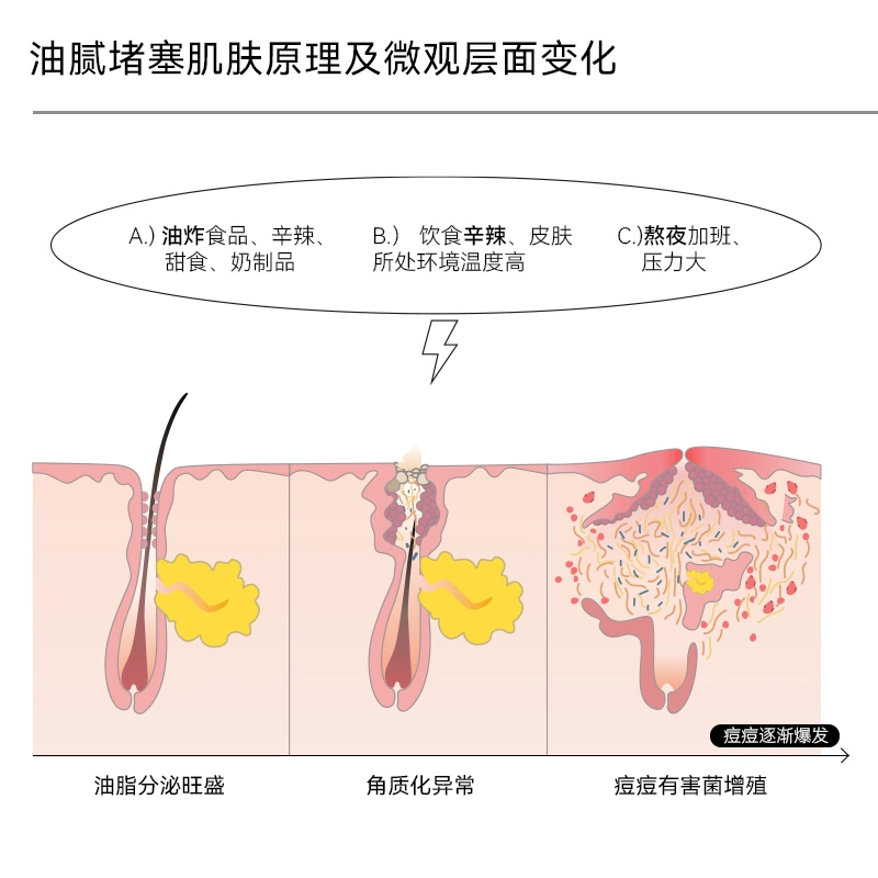 德国哈恩男士寡肽油痘肌水乳护肤品套装控油祛痘改善黑头粉刺哈嗯