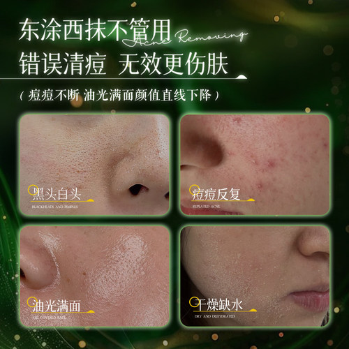 【官方正品】植祛小绿瓶祛痘精华液祛痘温和黑头粉刺闭口青少年DS - 图0