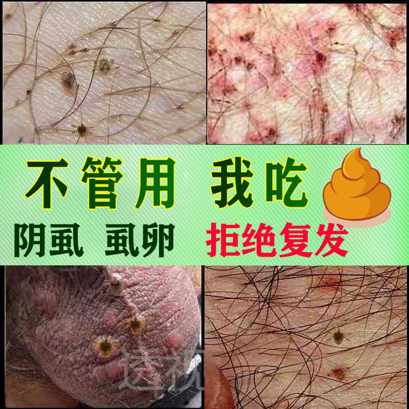 灭虱剂 新人首单立减十元 22年1月 淘宝海外