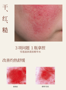 【云朵艾杨】雪莲修护滋润精华水