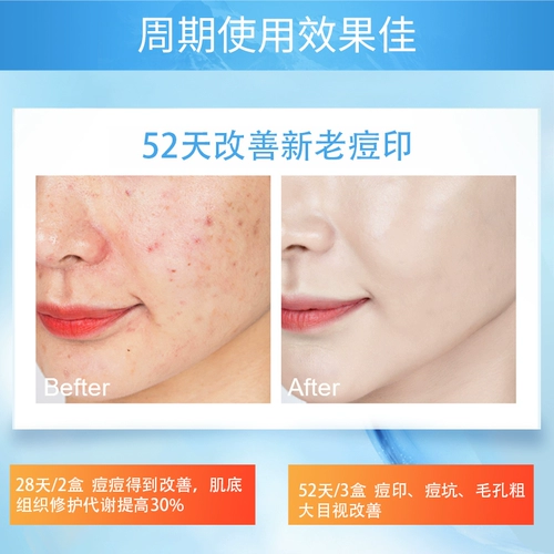 Олигопептид, лиофилизированный порошок, восстанавливающая осветляющая сыворотка для лица, анти-акне, скрывает прыщи, официальный продукт