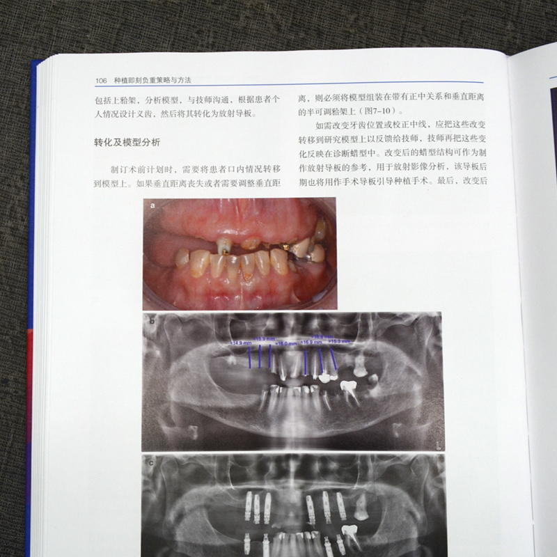 正版 种植即刻负重策略与方法 负重的诊断和治疗计划 修复诊断 美学区单颗多颗牙的临时修复 即刻功能负重临床技术指导手术方案 - 图2