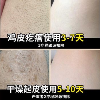 ສິວໄກ່, ຢາຂີ້ເຜິ້ງ follicular keratosis, ຜິວຫນັງແຫ້ງ, ຢາຂີ້ເຜິ້ງ keratosis pilaris, ຄີມຜິວຫນັງ ichthyosis