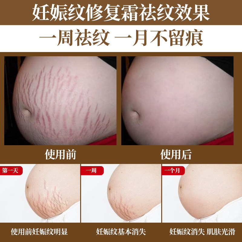 倍可悦孕妇专用去妊娠纹预防修复霜 倍可悦妊娠纹护理